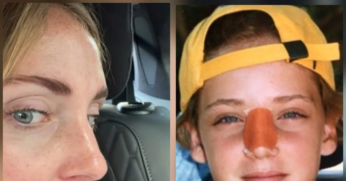 chiara ferragni racconta perch233 ha una leggera gobbetta sul naso la foto da bambina dopo un incidente a maui mentre faceva bodysurf da Ilgiornaleditalia.it chiara ferragni racconta perch233 ha una leggera gobbetta sul naso la foto da bambina dopo un incidente a maui mentre faceva bodysurf